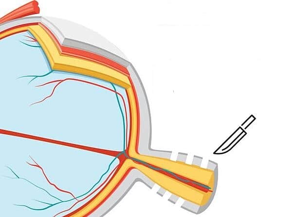 Khi bạn có giả u não, bạn cần phải đi khám mắt thường xuyên để theo dõi những thay đổi trong diễn tiến bệnh