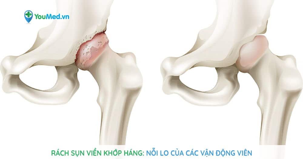 Rách sụn viền khớp háng: Nỗi lo của các vận động viên