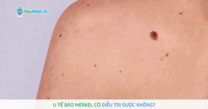 U tế bào Merkel có điều trị được không?
