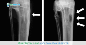 Bệnh viêm tủy xương: Cách chẩn đoán và điều trị