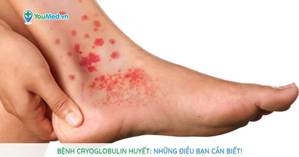 Bệnh cryoglobulin huyết: Những điều bạn cần biết!