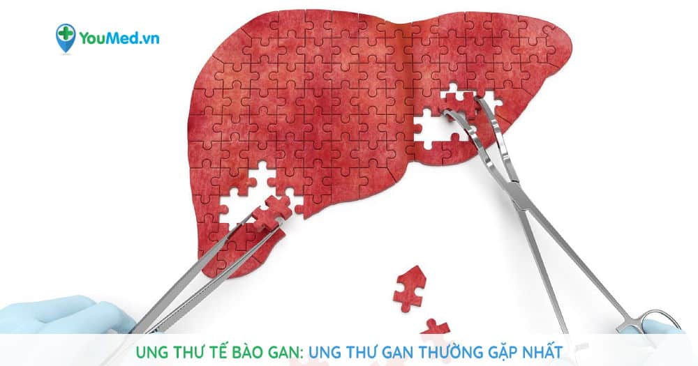 Ung thư tế bào gan: Ung thư gan thường gặp nhất