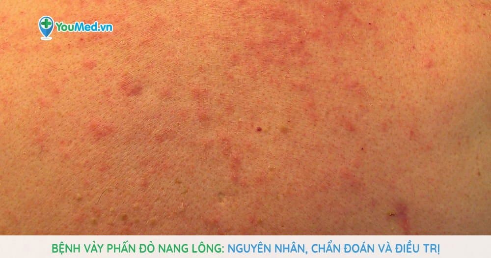 Bệnh vảy phấn đỏ nang lông: Nguyên nhân, chẩn đoán và điều trị
