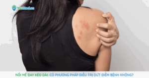 Nổi mề đay kéo dài: Có phương pháp điều trị dứt điểm không?