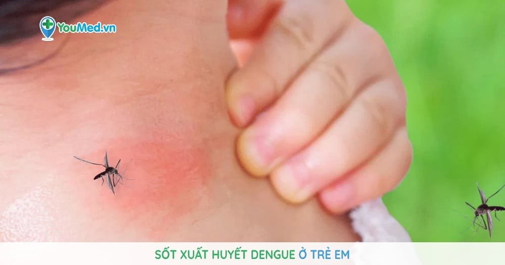 Sốt xuất huyết Dengue ở trẻ em
