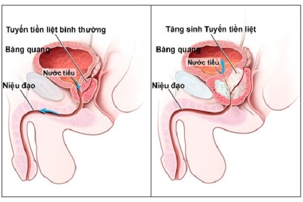 Tăng sản lành tính tiền liệt tuyến