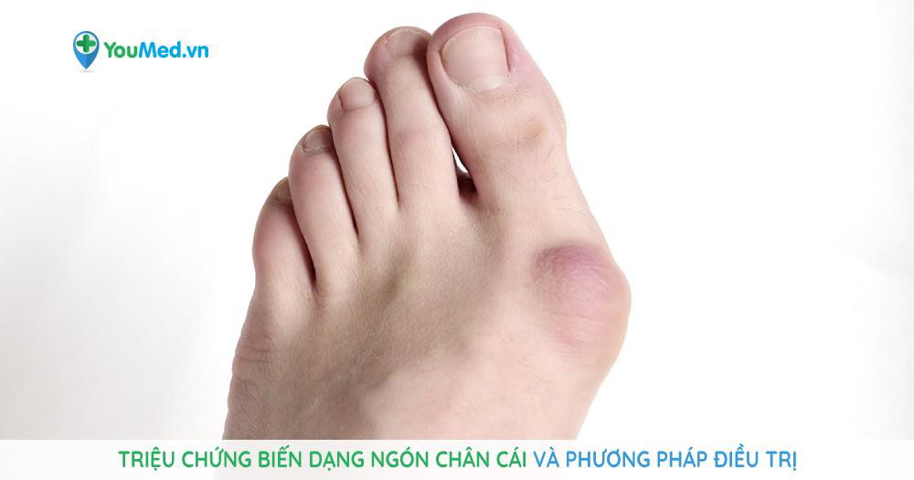 Biến dạng ngón chân cái: triệu chứng, nguyên nhân và phương pháp ...