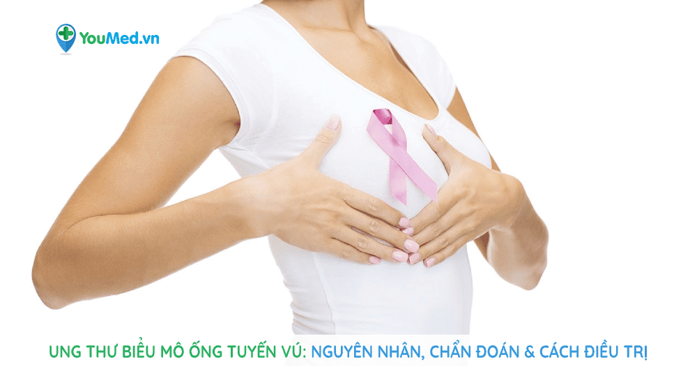 Ung thư biểu mô ống tuyến vú: nguyên nhân, chẩn đoán và điều trị