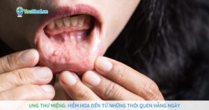 Ung thư miệng: Hiểm hoạ đến từ những thói quen hằng ngày