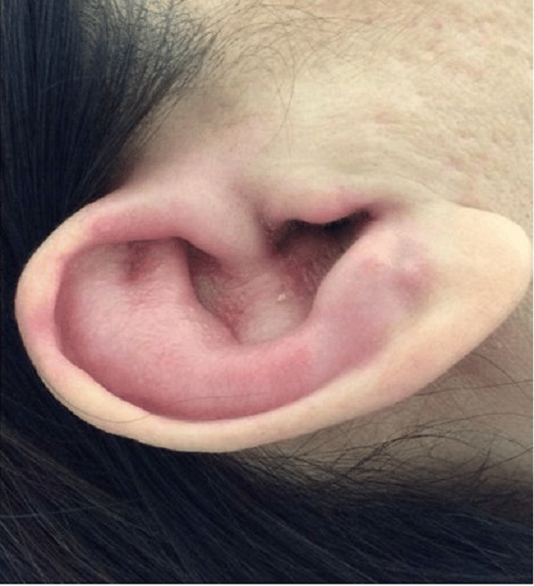 Đau, đỏ da vùng tai là những triệu chứng thường gặp