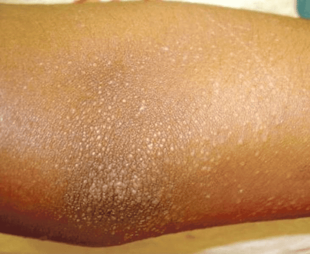 Triệu chứng bệnh Lichen nitidus