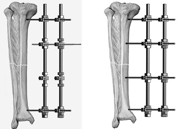 Dùng ốc vít để cố định chân