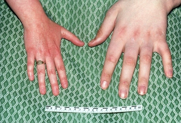 Bàn tay của người bình thường so với người mắc bệnh to đầu chi
