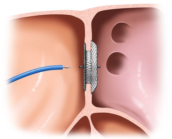 Điều trị can thiệp tim mạch bằng catheter có thể giúp sửa chữa dị tật thông liên nhĩ