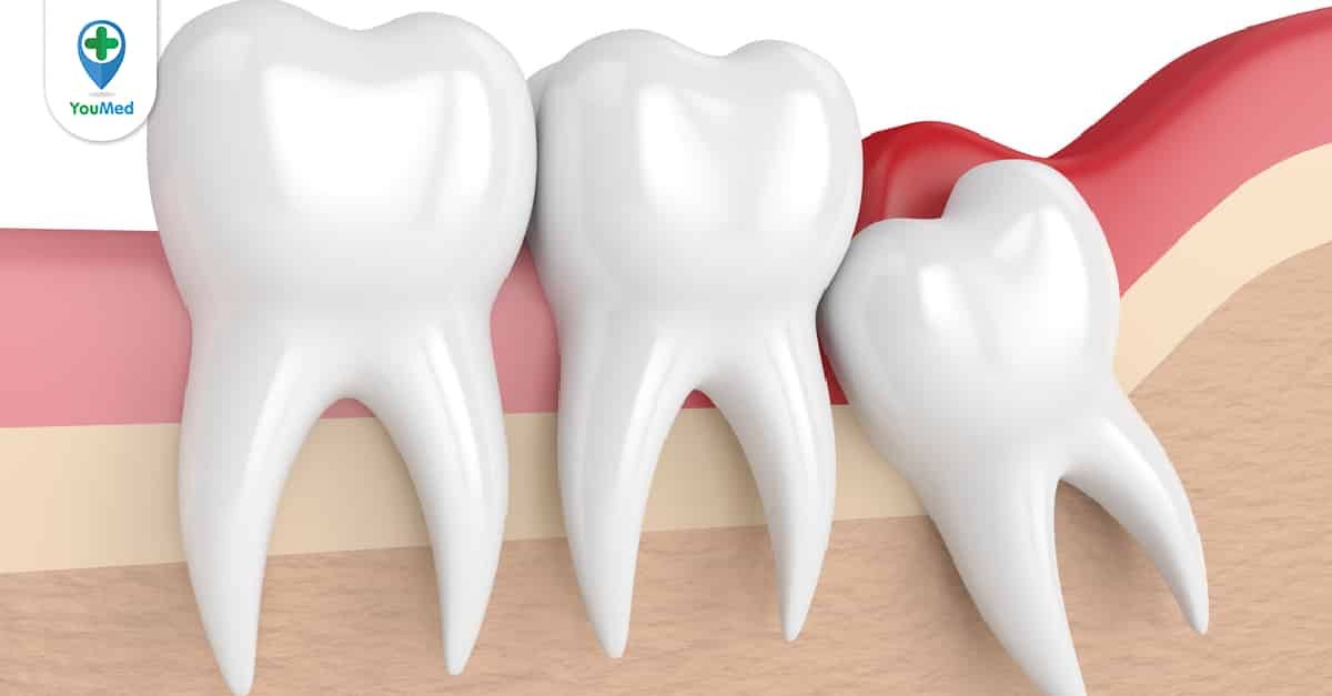 Các răng 1 chân thường nằm ở vị trí nào trong hàm trên và dưới?
