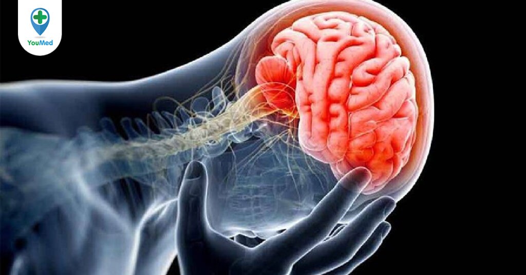 Bệnh não chấn thương mãn tính (CTE): nguyên nhân, triệu chứng và cách điều trị