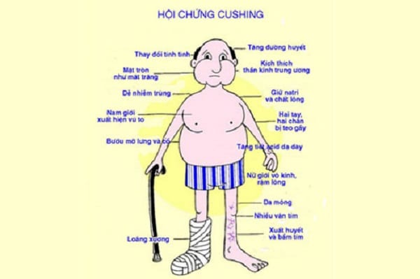 Hội chứng Cushing