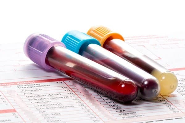 Bác sĩ có thể cho xét nghiệm máu với bệnh đau xơ cơ ở thiếu niên