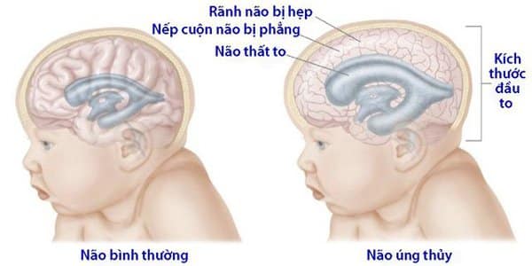 Bệnh có thể dẫn đến biến chứng là não úng thủy