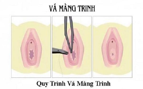 Vá màng trinh