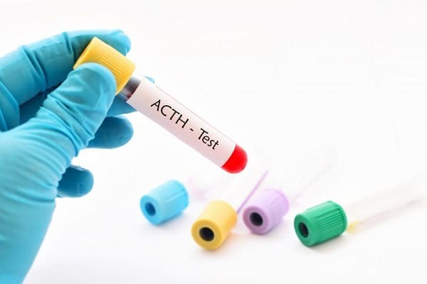 Nồng độ ACTH được kiểm tra bằng cách lấy một mẫu máu từ tĩnh mạch