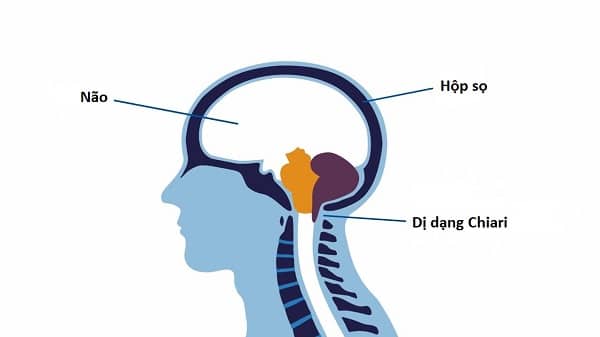 Dị dạng Chiari do một phần não bị tụt xuống khoang tủy