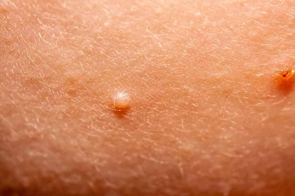 Các nốt do virus Molluscum contagiosum gây nên 