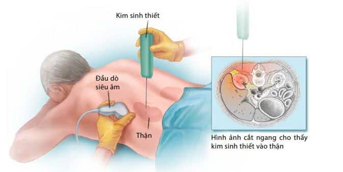 Sinh thiết thận dưới hình ảnh siêu âm