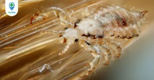 Điều trị rận cơ thể bằng cách nào?