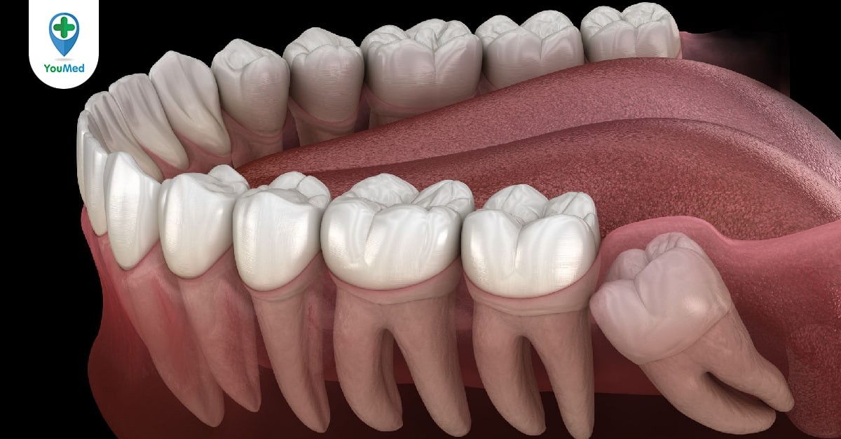  Giải phẫu răng 6 hàm trên : Một cái nhìn tổng quan và các yếu tố ảnh hưởng