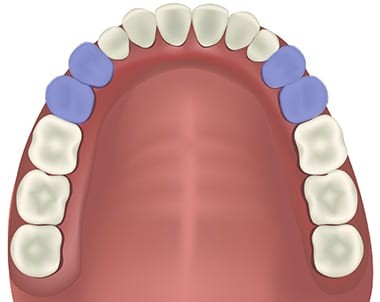 răng cối nhỏ hàm trên