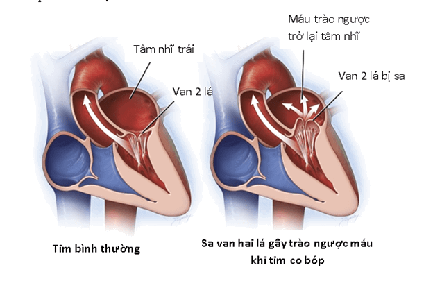 4. Các phương pháp chẩn đoán sa van tim