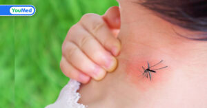 Sốt xuất huyết Dengue ở trẻ em