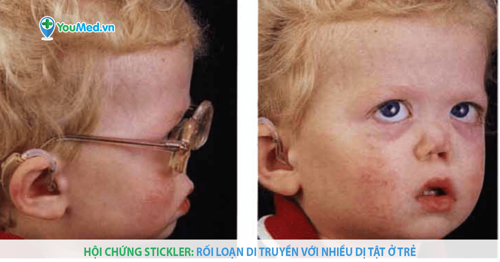Hội chứng Stickler: bệnh khớp – mắt di truyền tiến triển