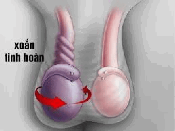 Tinh hoàn bị xoắn