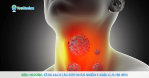 Tăng bạch cầu đơn nhân nhiễm khuẩn: căn bệnh lây qua nụ hôn