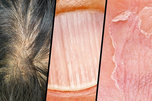 Thiếu hụt protein có thể dẫn đến các vấn đề ở: da, tóc, móng