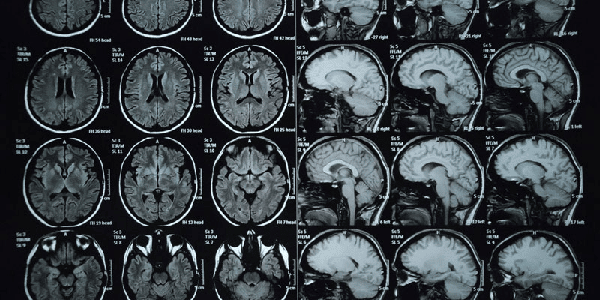 Chất cản quang có chứa gadolinium khi chụp MRI có thể là nguyên nhân gây bệnh
