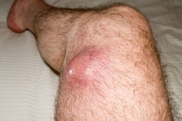 Một khối u mô mềm ở chân