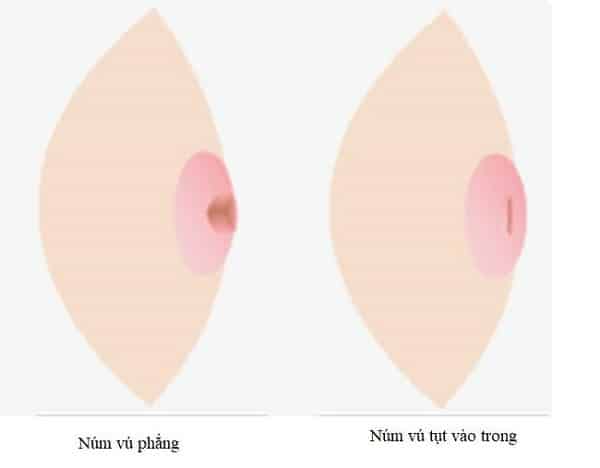 Hình ảnh núm vú bị tụt vào trong so với bình thường