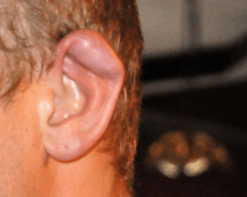 Hình ảnh tụ dịch vành tai