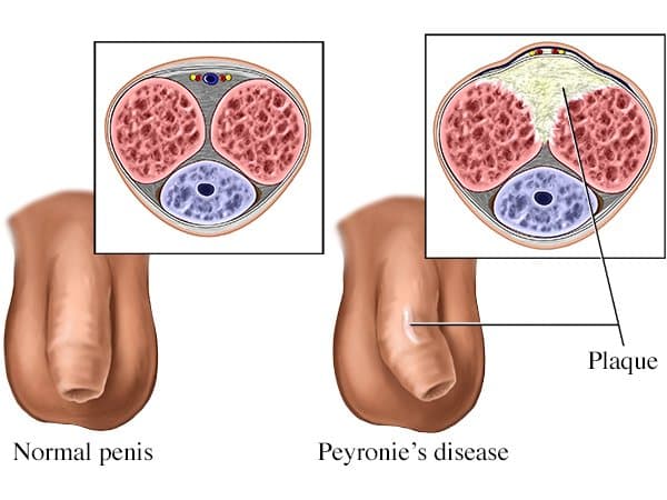 Bệnh Peyronie - gây bệnh liệt dương