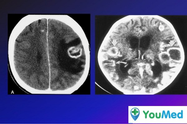 CT Scan trong viêm màng não do lao