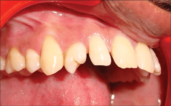 Bất thường mọc răng: Chuyển vị răng nanh và răng cối nhỏ