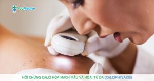 Hội chứng calci hóa mạch máu và hoại tử da (Calciphylaxis)