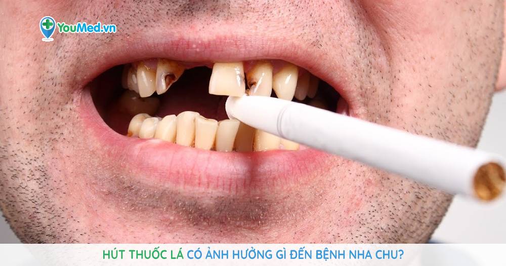 Hút thuốc lá có ảnh hưởng gì đến bệnh nha chu?