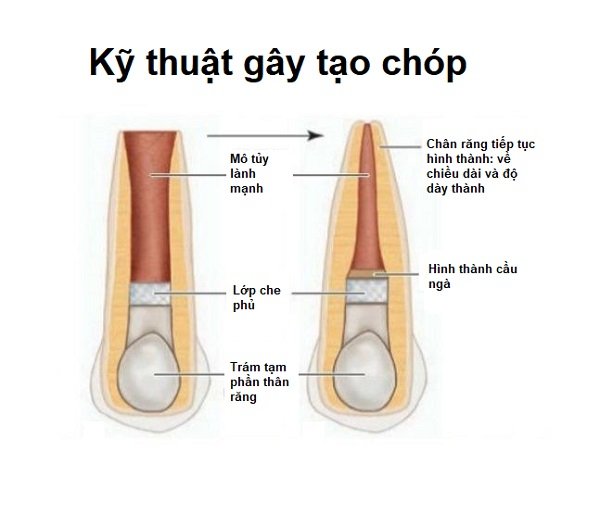 Kích tạo chóp