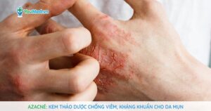 Azacné: Kem thảo dược chống viêm, kháng khuẩn cho da mụn