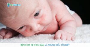 Bệnh hạt kê (mụn sữa) và những điều cần biết