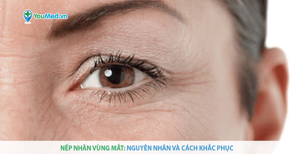 Nếp nhăn vùng mắt có dễ xóa hay không?
